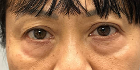 1_0000_patient 5 before quad bleph with fat grafting- front.png