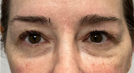 1_0001_BY BONNIE patient 20 after dissolving under eye filler.png