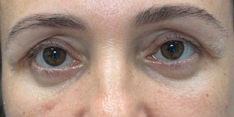 1_0001_patient 13 after lower bleph with facial fat grafting.png