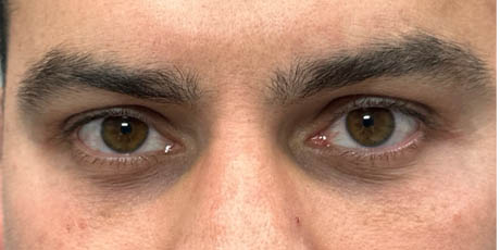 1_0001_patient 3 after peri-orbital ultraclear.png