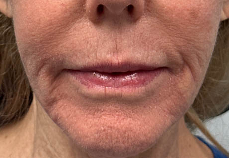 1_0001_patient 3 before filler corners of mouth.png