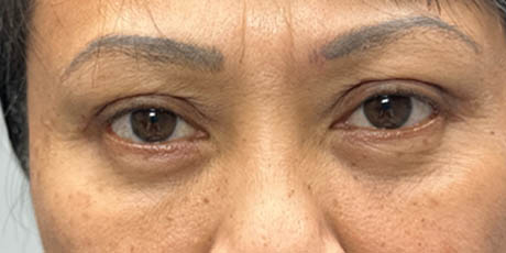 1_0001_patient 5 after quad bleph with fat grafting- front.png