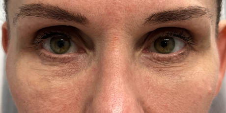 1_0002_patient 11 before peri-orbital ultraclear.png