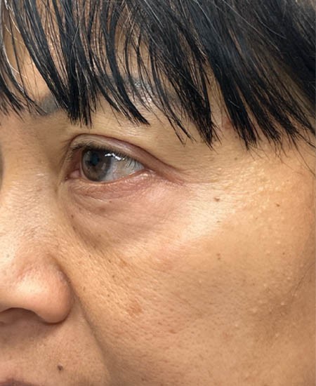 1_0002_patient 5 before quad bleph with fat grafting- left side.png