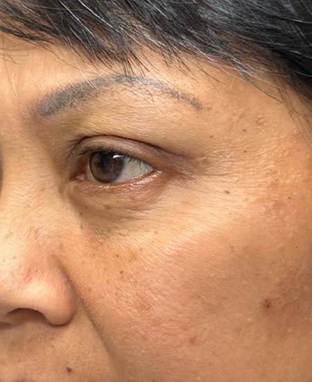 1_0003_patient 5 after quad bleph with fat grafting- left side.png