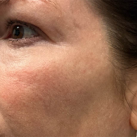 1_0004_patient 10 before ultraclear for scars– left side.png