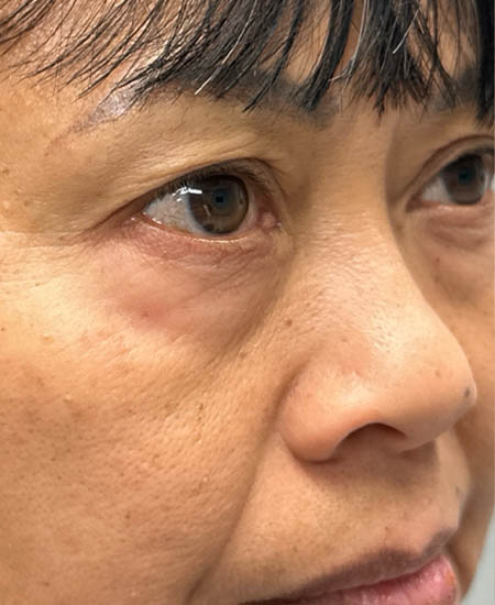 1_0004_patient 5 before quad bleph with fat grafting- right side.png