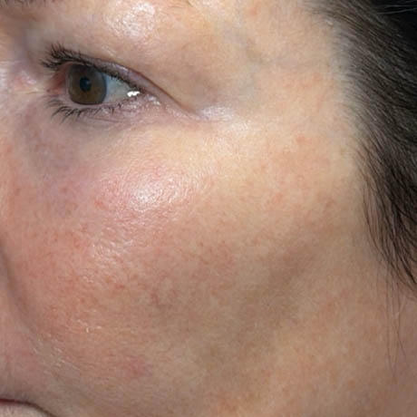 1_0005_patient 10 after ultraclear for scars– left side.png