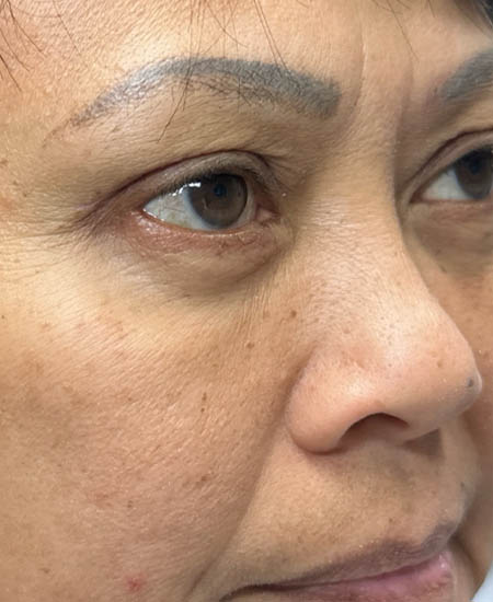 1_0005_patient 5 after quad bleph with fat grafting- right side.png