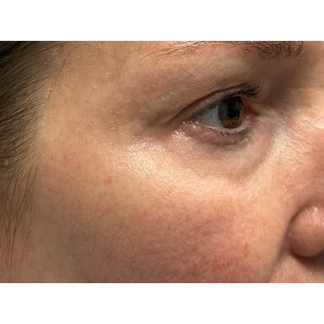 1_0006_patient 10 before ultraclear for scars– right side.png