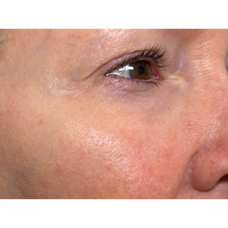 1_0007_patient 10 after ultraclear for scars– right side.png