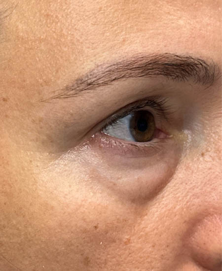 2_0002_patient 13 before lower bleph with facial fat grafting- side.png