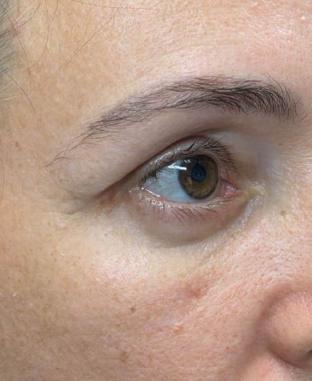 2_0003_patient 13 after lower bleph with facial fat grafting- side.png