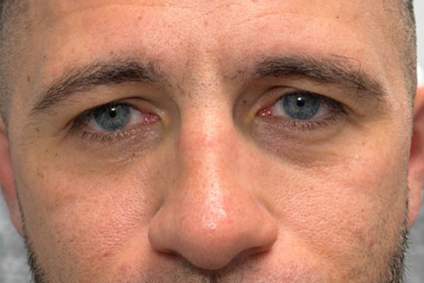 a_0003_patient 12 after cheek filler and morpheus- front.png