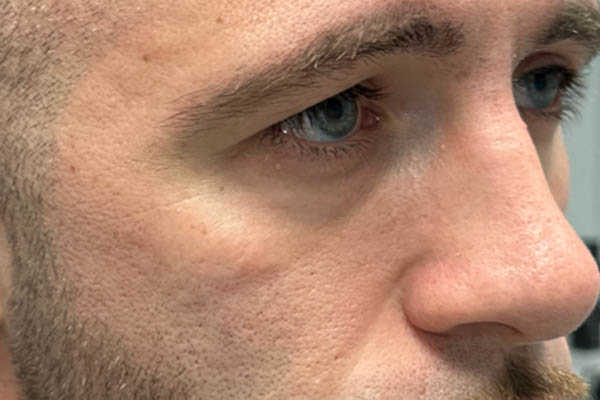 a_0004_patient 12 before cheek filler and morpheus- side.png