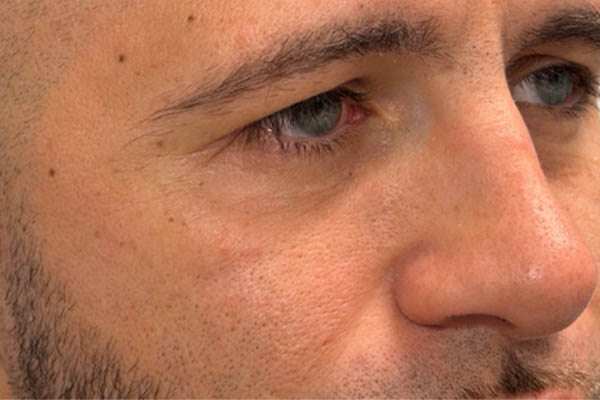 a_0005_patient 12 after cheek filler and morpheus- side.png