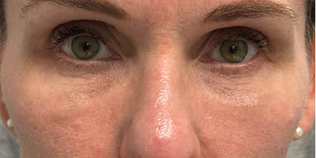 httpswww.lewencosmetic.combefore-after-plastic-surgery-miamiultra-clear-laser11317
