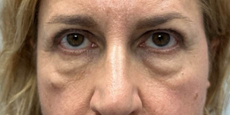 12_0014_patient 62 before lower bleph with facial fat grafting.png