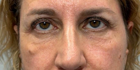 12_0015_patient 62 after lower bleph with facial fat grafting.png