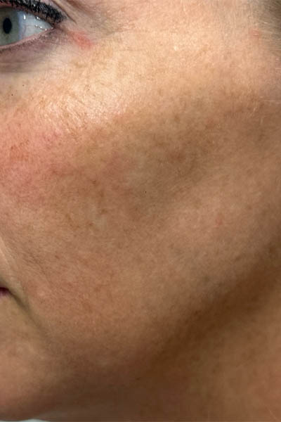 1_0000_patient 12 before ultraclear with laser coring- left side.png