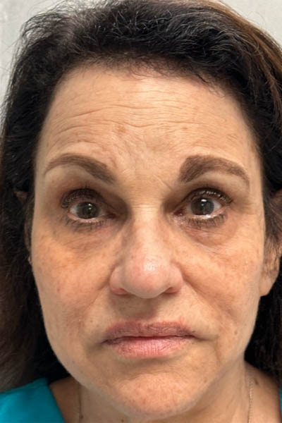 1_0000_patient 13 after ultraclear with laser coring.png