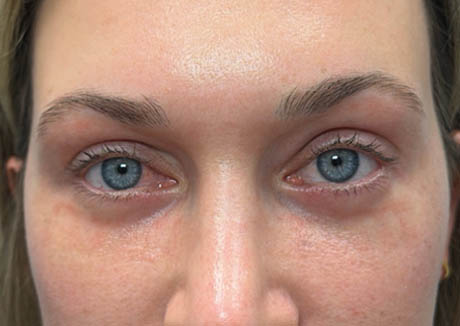 1_0000_patient 14 after lower bleph with facial fat grafting and CO2 laser.png
