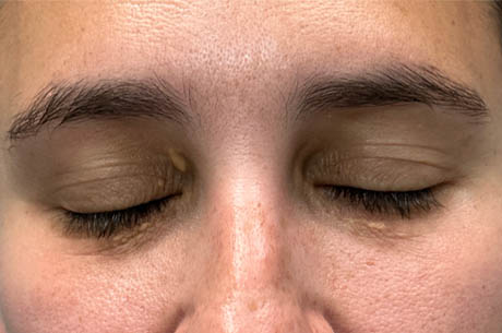 1_0000_patient 15 before xanthelasma excision- closed.png