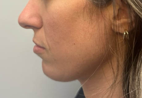 1_0000_patient 17 before chin filler.png