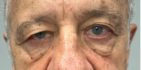 1_0000_patient 19 before upper bleph with direct browlift- front.png