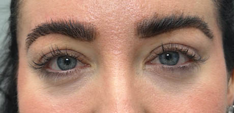 1_0000_patient 20 after upper bleph with ptosis repair and subbrow filler.png