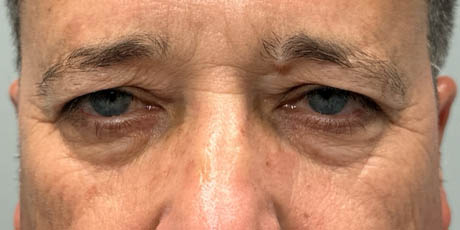 1_0000_patient 21 before quad bleph with CO2, facial fat grafting and direct brow lift- front.png