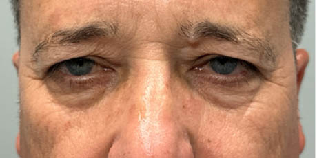 1_0000_patient 21 before quad bleph with CO2, facial fat grafting and direct brow lift- front.png