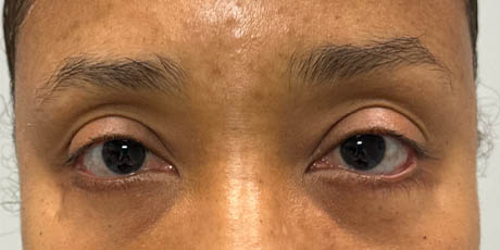 1_0000_patient 4 before lower bleph revision with hard palate grafts, mid face lift and canthoplasty- front.png