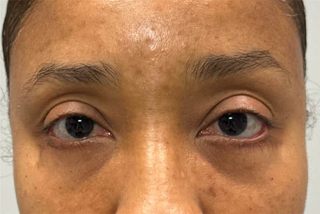 1_0000_patient 4 before lower bleph revision with hard palate grafts, mid face lift and canthoplasty- front.png