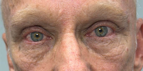 1_0000_patient 5 after upper bleph with direct browlift and sub-brow filler.png