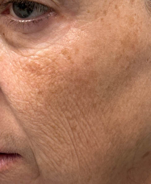 1_0000_patient 8 before CO2 laser- left side.png