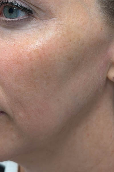 1_0001_patient 12 after ultraclear with laser coring- left side.png