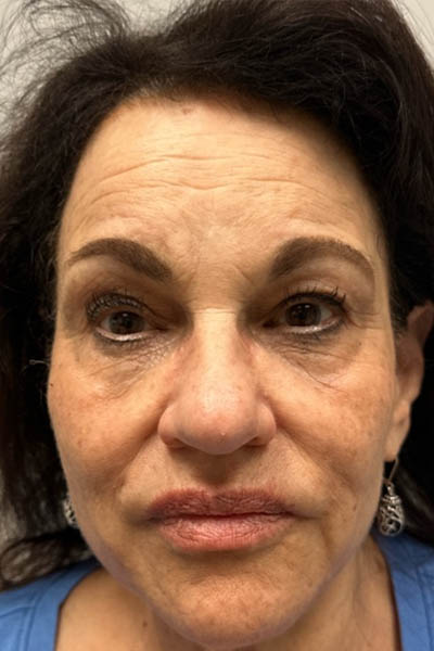 1_0001_patient 13 before ultraclear with laser coring.png