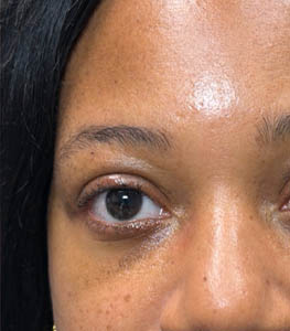 1_0001_patient 14 after chalazia removal- side.png