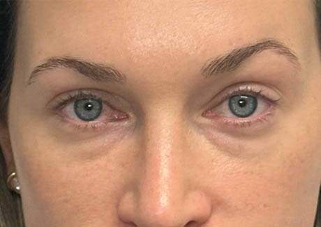 1_0001_patient 14 before lower bleph with facial fat grafting and CO2 laser.png