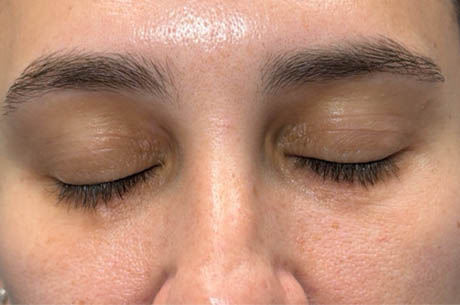 1_0001_patient 15 after xanthelasma excision- closed.png