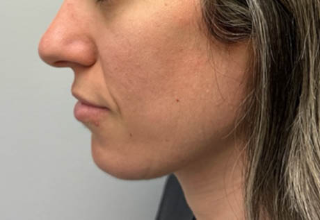 1_0001_patient 17 after chin filler.png