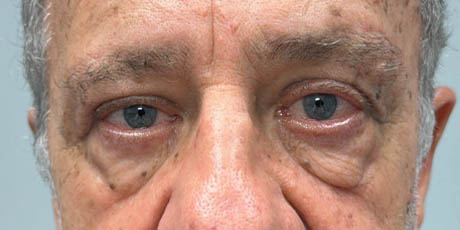 1_0001_patient 19 after upper bleph with direct browlift- front.png
