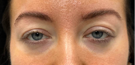 1_0001_patient 20 before upper bleph with ptosis repair and subbrow filler.png