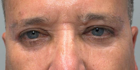 1_0001_patient 21 after quad bleph with CO2, facial fat grafting and direct brow lift- front.png