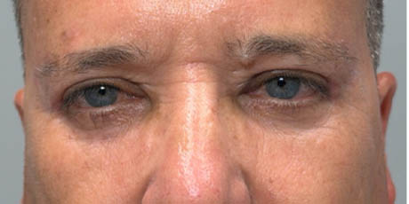 1_0001_patient 21 after quad bleph with CO2, facial fat grafting and direct brow lift- front.png