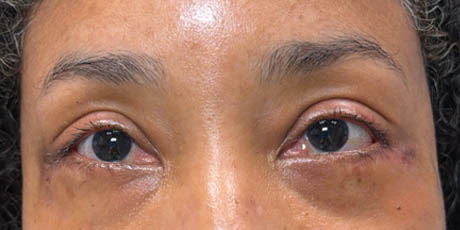 1_0001_patient 4 after lower bleph revision with hard palate grafts, mid face lift and canthoplasty- front.png