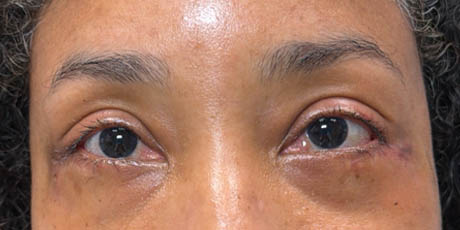 1_0001_patient 4 after lower bleph revision with hard palate grafts, mid face lift and canthoplasty- front.png