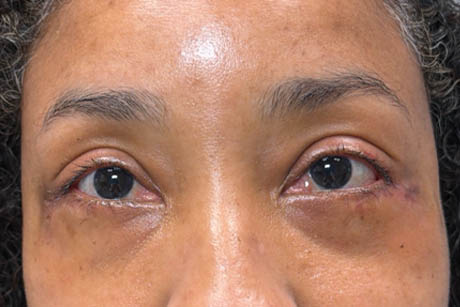 1_0001_patient 4 after lower bleph revision with hard palate grafts, mid face lift and canthoplasty- front.png