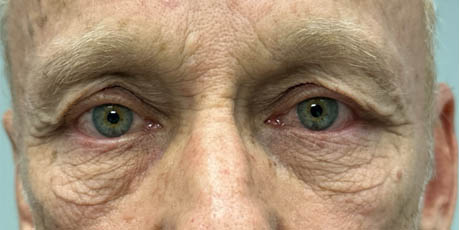 1_0001_patient 5 before upper bleph with direct browlift and sub-brow filler.png